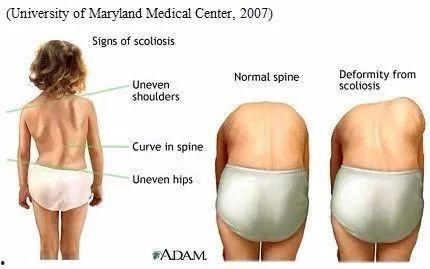 成人脊柱侧弯50度视频,揭秘病因与康复之道