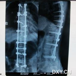 成人脊柱侧弯50度视频,揭秘病因与康复之道